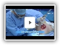 Breast Augmentation Surgery 2